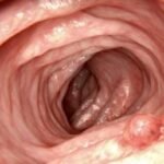7 Sintomas De Cancer De Colon Que Fatalmente Confundimos Con Males Estomacales