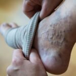 9 remedios naturales para aliviar el malestar de las varices.