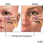Cómo prevenir la muerte por otitis en tus hijos, por favor no dejes que les suceda.