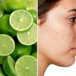 5 Recetas Caseras Y Sumamente Efectivas Para Eliminar El Acne