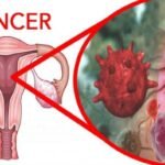 Cancer De Ovario Otro Asesino Silencioso 6 Senales Y 3 Datos Importantes