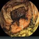 7 Cosas Que Haces Todos Los Dias Y Que Incrementan Tus Posibilidades De Tener Cancer De Esofago