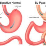 Alguien En Tu Familia Sufre De Obesidad Todo Lo Que Debes Saber Sobre El Baypass Gastrico